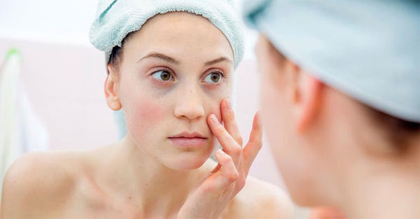 5 Tips to Reduce Hormonal Acne Breakout