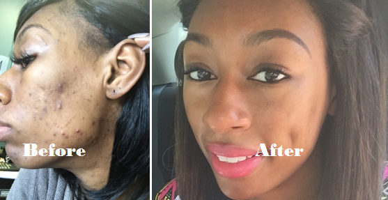 How Lala Got Glowing Skin and How You Can Too