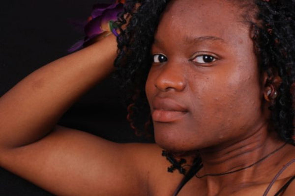 The Truth behind Adult Acne and How to Deal With Them